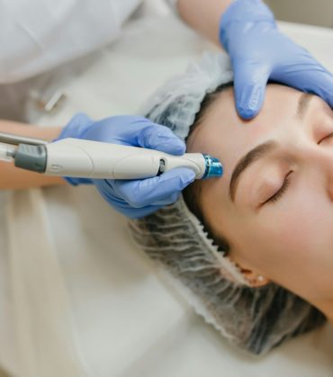 Microneedling